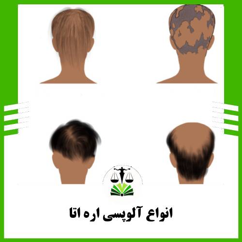 انواع آلوپسی اره اتا