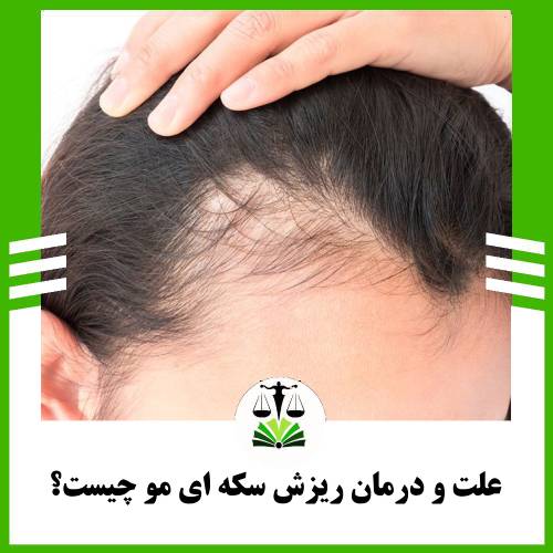 علت و درمان ریزش سکه ای مو چیست؟